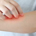 Tips Merawat Kulit Sensitif