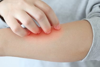 Tips Merawat Kulit Sensitif