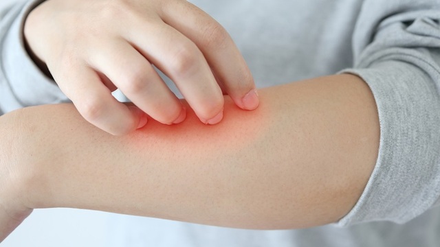 Tips Merawat Kulit Sensitif