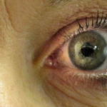 Penyebab Glaukoma Pada Mata Beserta Gejalanya Yang Perlu Diketahui!