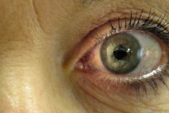 Penyebab Glaukoma Pada Mata Beserta Gejalanya Yang Perlu Diketahui!