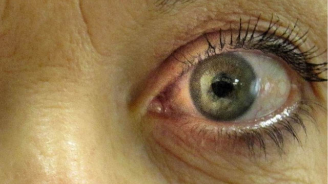 Penyebab Glaukoma Pada Mata Beserta Gejalanya Yang Perlu Diketahui!